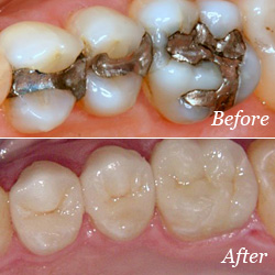 teeth before and after fillings