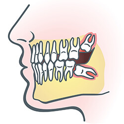 wisdom teeth illustration